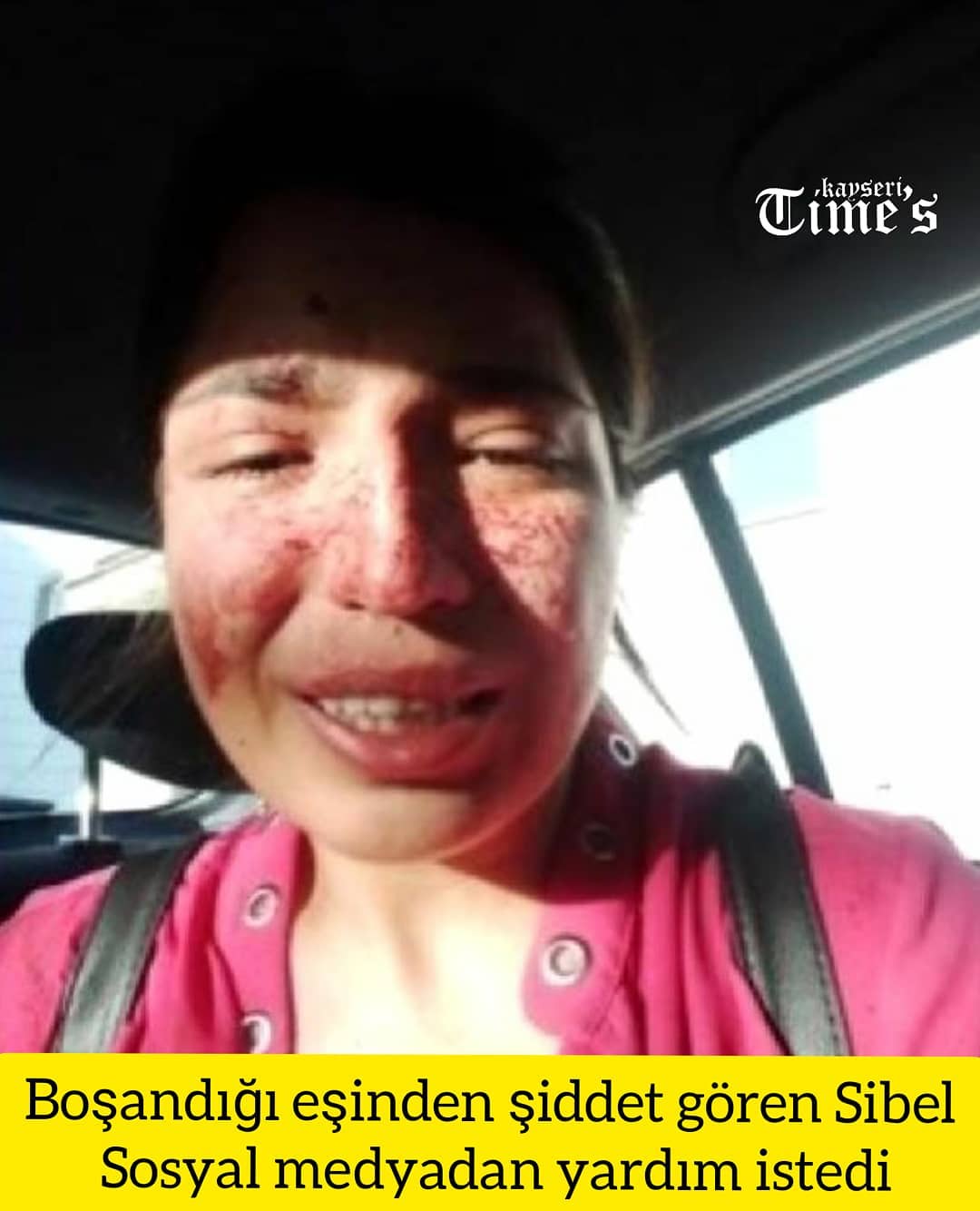 Boşandığı eşinden şiddet gören Sibel sosyal medyadan yardım istedi