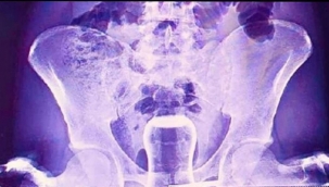 Şanlıurfa'da tedavi için hacamat yaptıran basur hastası bir kişinin anüs bölgesine yağlı çay bardağı kaçtı.