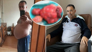 Şişlik ve kilo şikayeti ile gitti karnından 35 kilo kitle çıkarıldı.