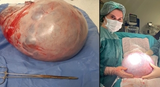 Karnından 9 kilo tümör çıktı!