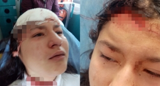 Öz çekim yaparken sokak köpeklerinin saldırısına uğrayan çocuk ölümden döndü