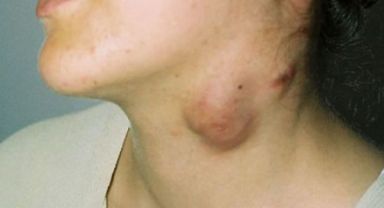 BOYUNDA ELE GELEN KİTLE, AĞIZDA YARA VE SES KISIKLIĞI KANSER HABERCİSİ OLABİLİR