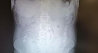 Kayseri'de uyuşturucu operasyonu: Midesi uyuşturucu deposu çıktı!