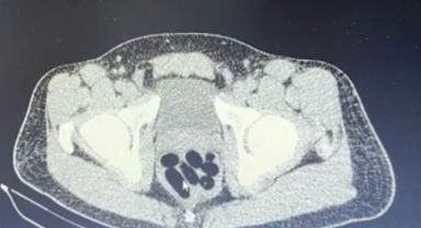 Midesinden 1 kilo uyuşturucu çıktı