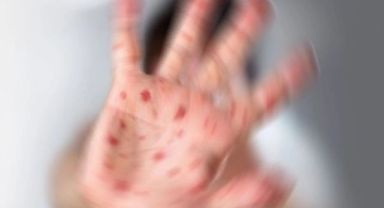 11 öğrencide görüldü! Solunum yolu ve temasla bulaşıyor