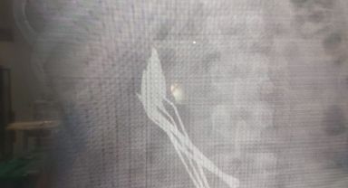 Çocuğun midesinden çıkanlar şaşırttı