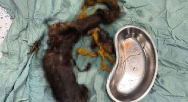 Kayseri'de 14 yaşındaki kızın midesinden 3.5 kilo saç kılı çıktı