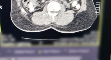 Mide ve bağırsağından uyuşturucu çıktı