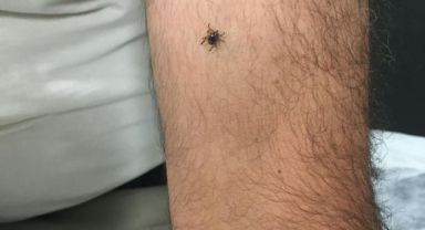 Kayseri’nin bir ilçesinde daha kene vakası